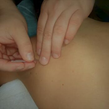 Myosynergy Balwyn massage & needling